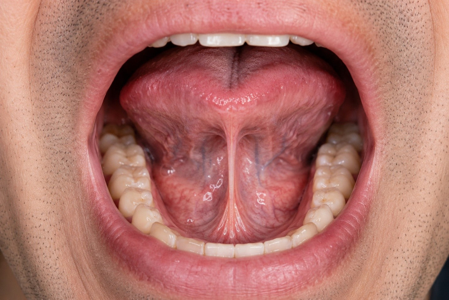 Adult Tongue Tie Symptoms and When to Get Evaluated