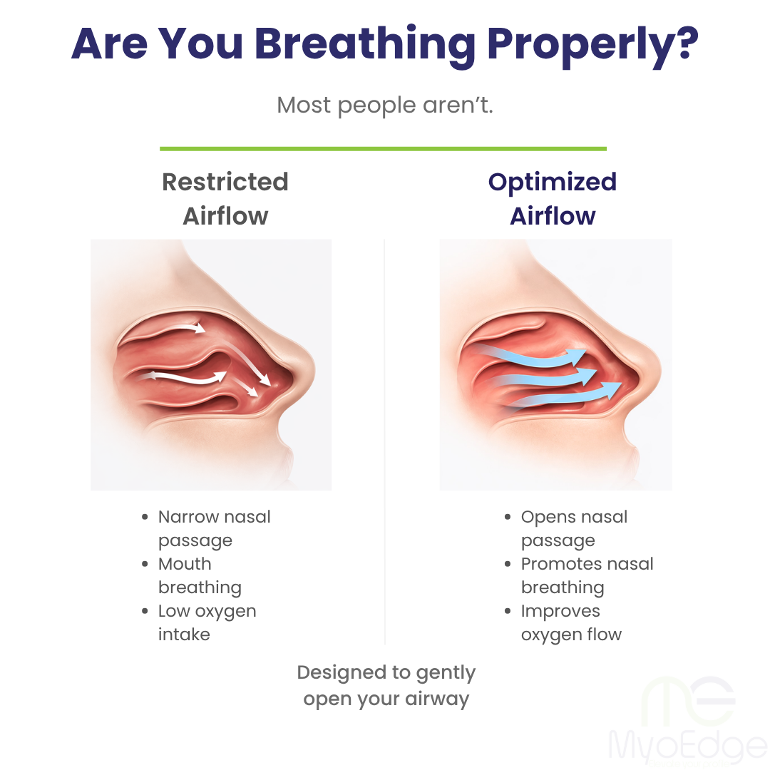 MyoEdge Nasal Dilator