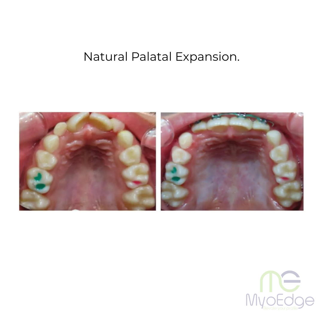 MyoEdge Tongue Positioner™