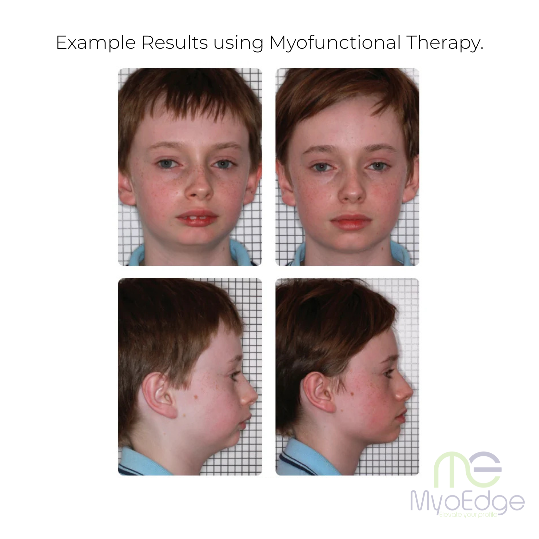 MyoEdge Tongue Positioner™